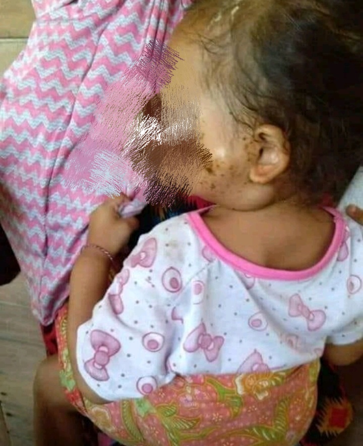 Bocah Penderita Kanker Asal Panipahan Butuh Uluran Tangan Dermawan